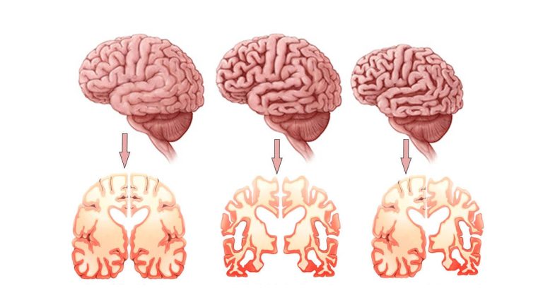 Wat zijn de oorzaken van de ziekte van Alzheimer?