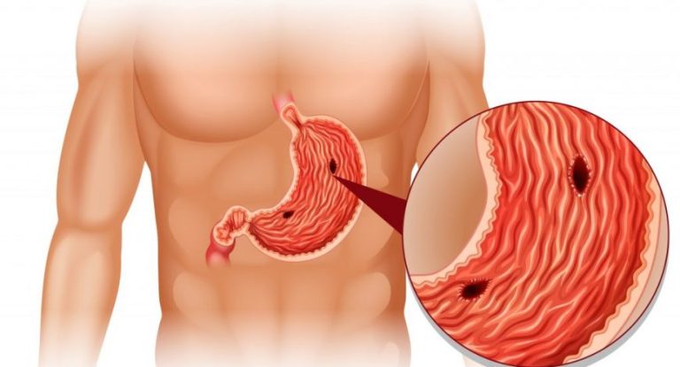 Wat zijn de oorzaken van maagzweren?